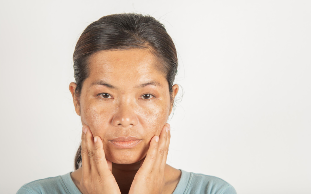 Melasma Treatment