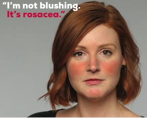 rosacea