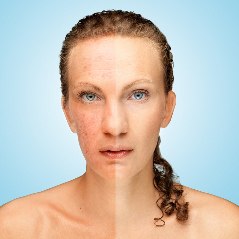 Acne Care