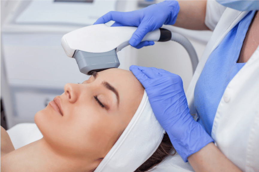 IPL treatment