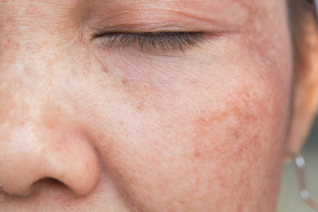 Sun spot or Melasma